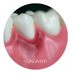 🪥 "Holistic Healing for Gum Infections: Natural Remedies for a Healthier Smile" 3 Gingivitis